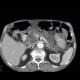 Intrapapillary mucinous neoplasm of pancreas, IPMN, central IPMN: CT - Computed tomography
